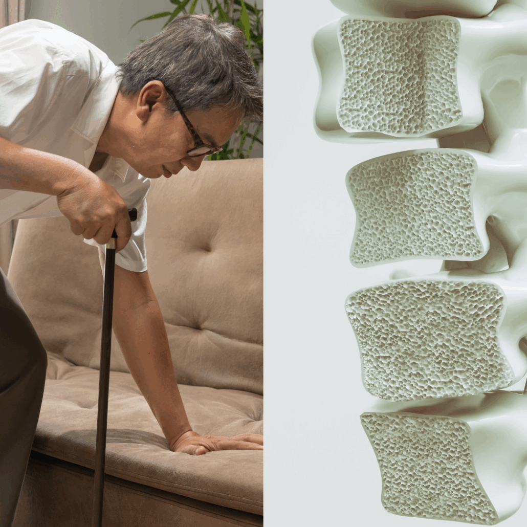 Sarcopenia & Osteoporosis