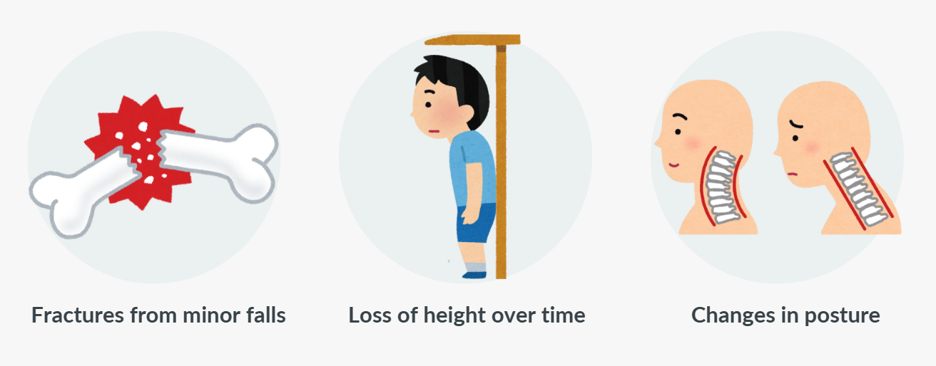 Osteoporosis Symptoms