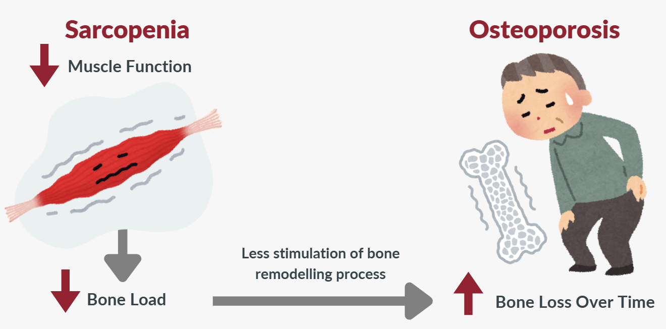 Connection between Sarcopenia and Osteoporosis